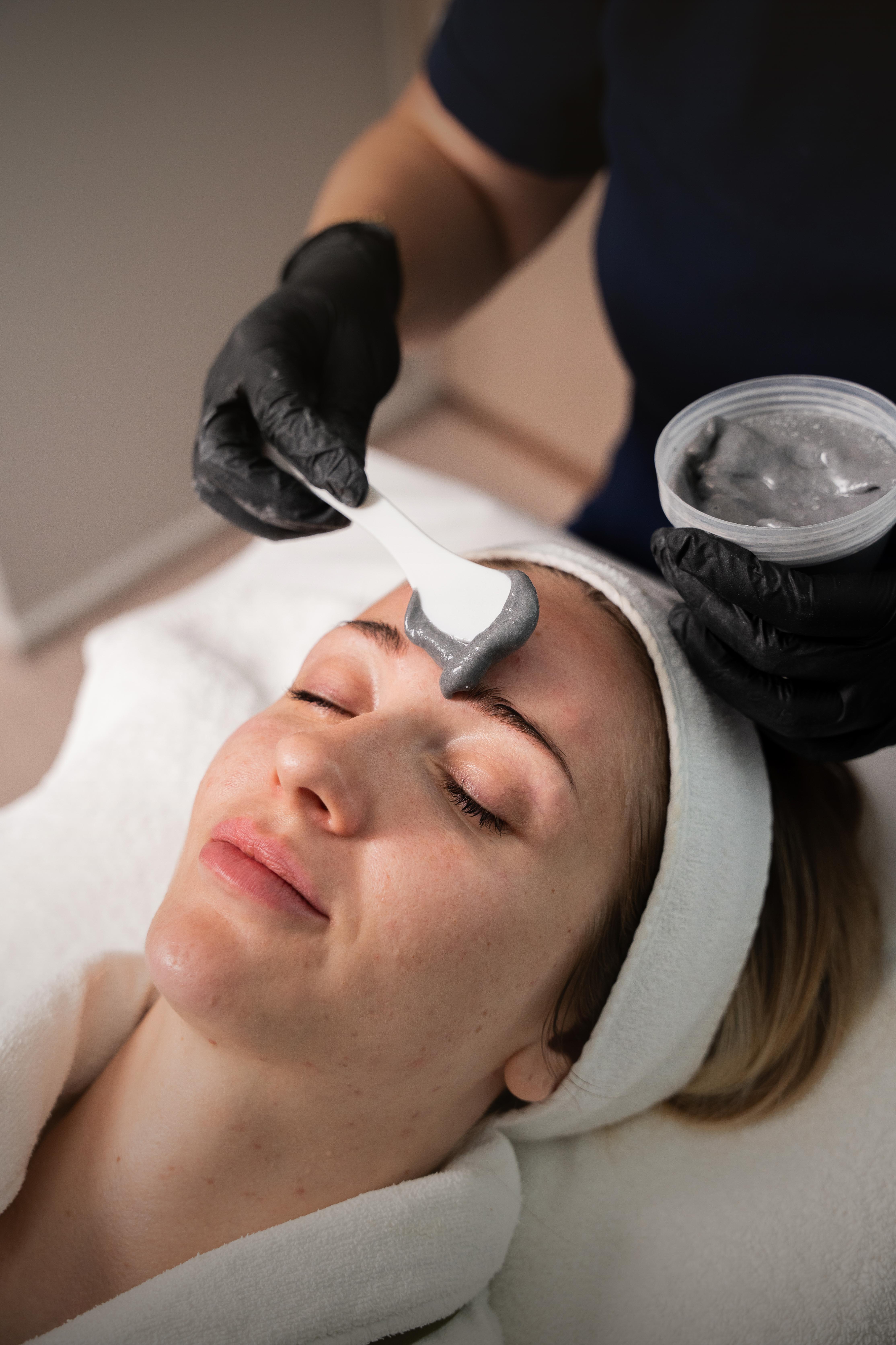 chemical peel treatment