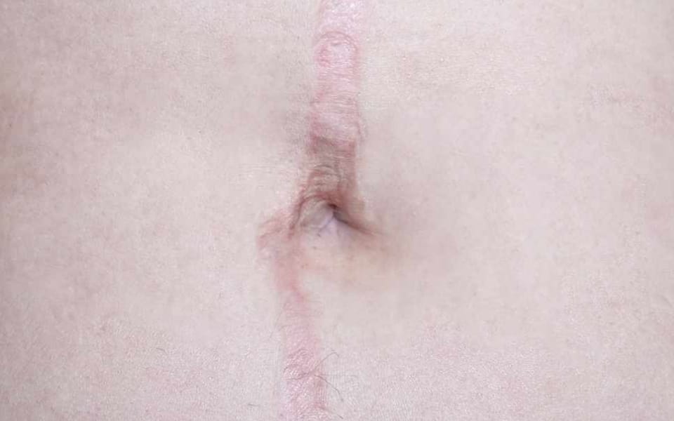 scar-treatment-before