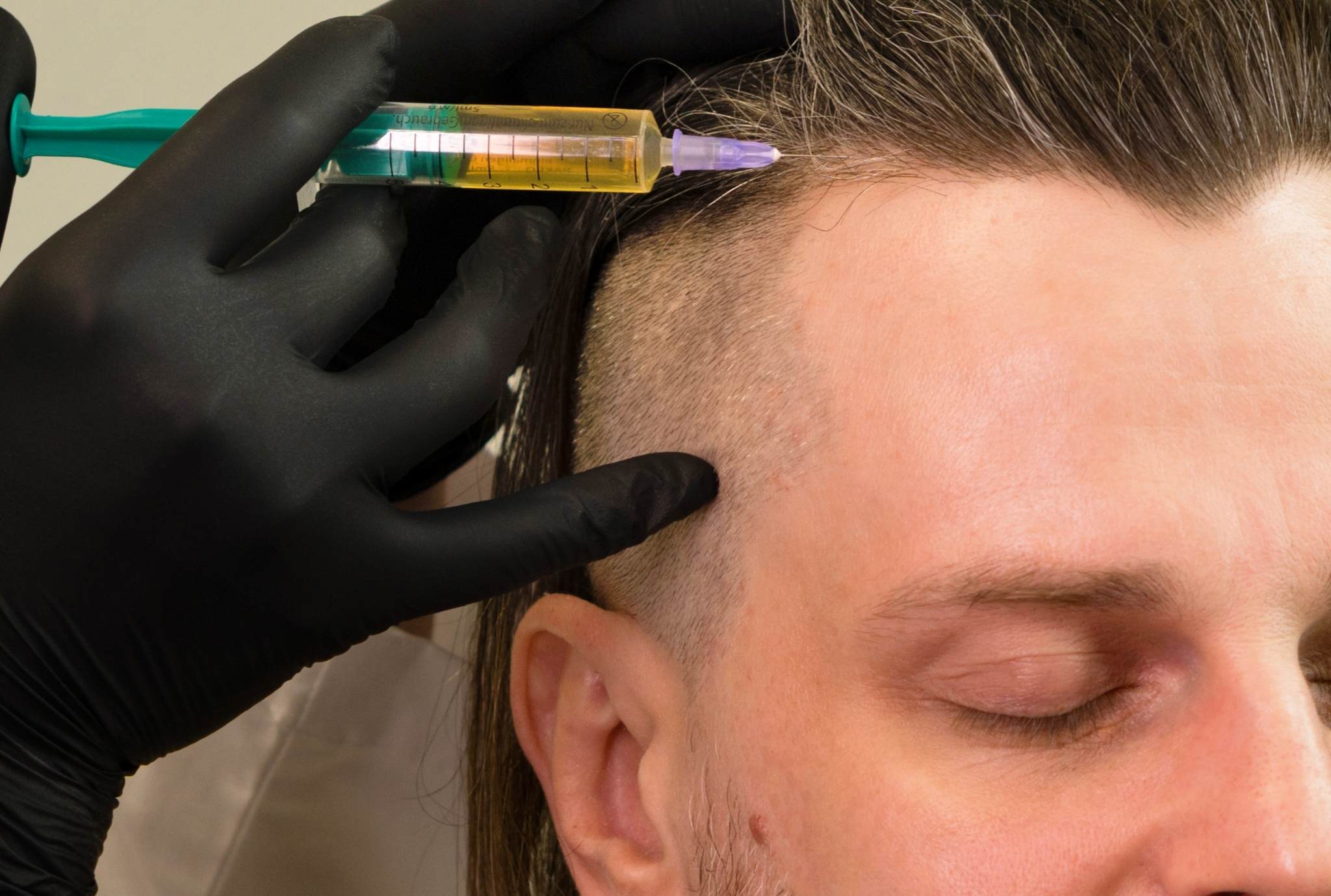 man doing acell for hair loss