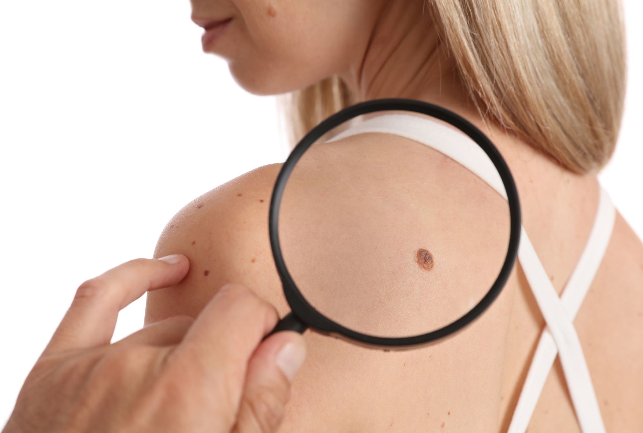 skin tag removal