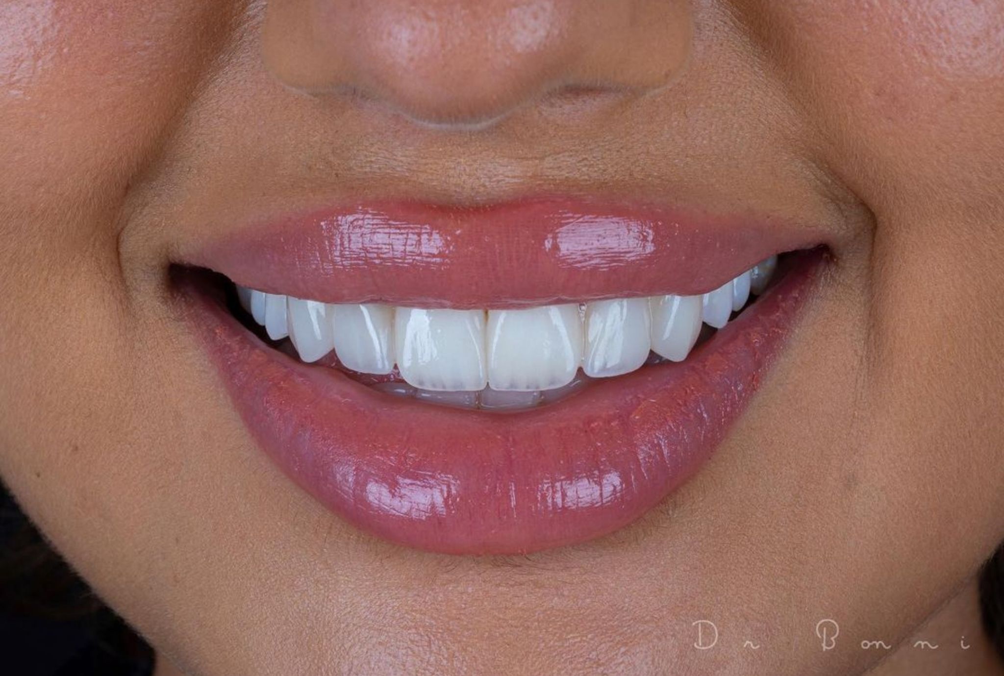 teeth veneer procedure