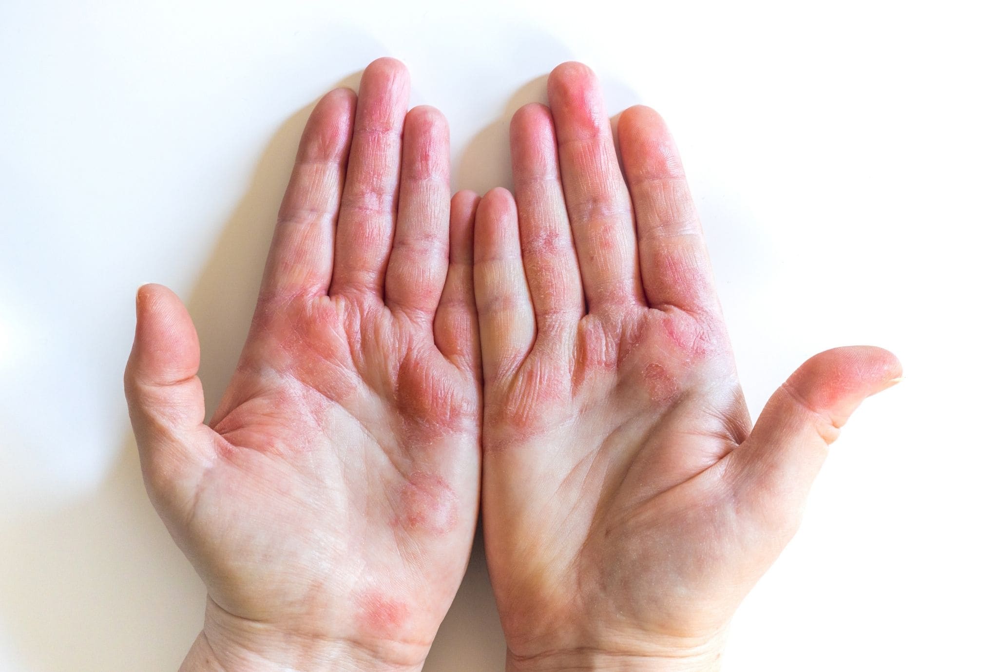 Types of Psoriasis​