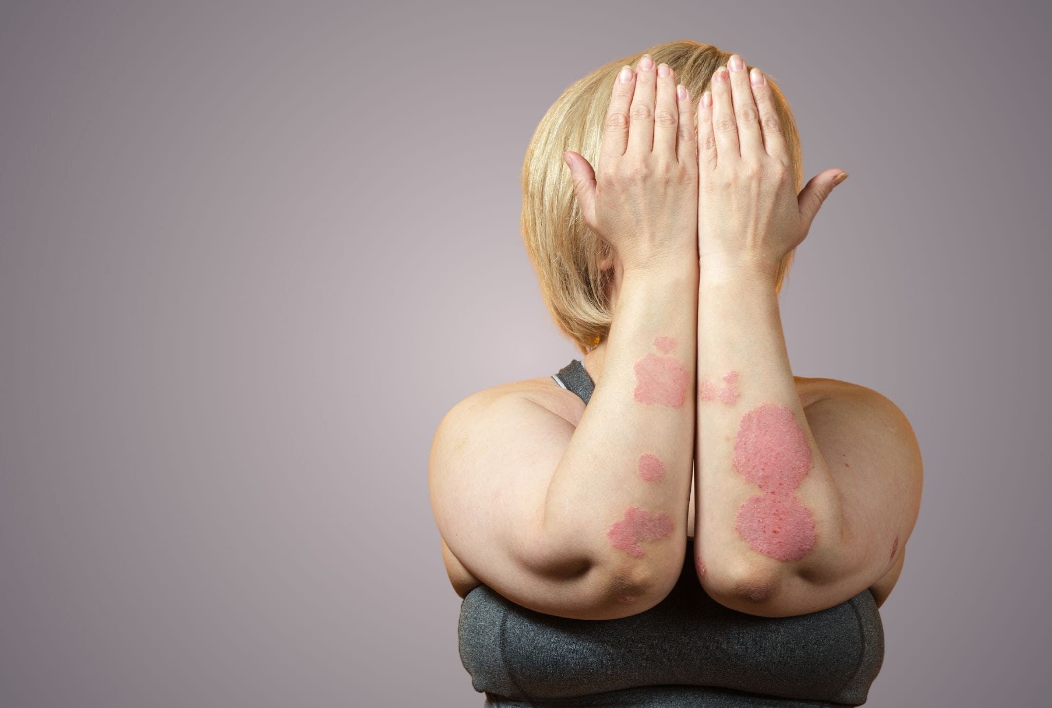 psoriasis treatment at hortman clinics