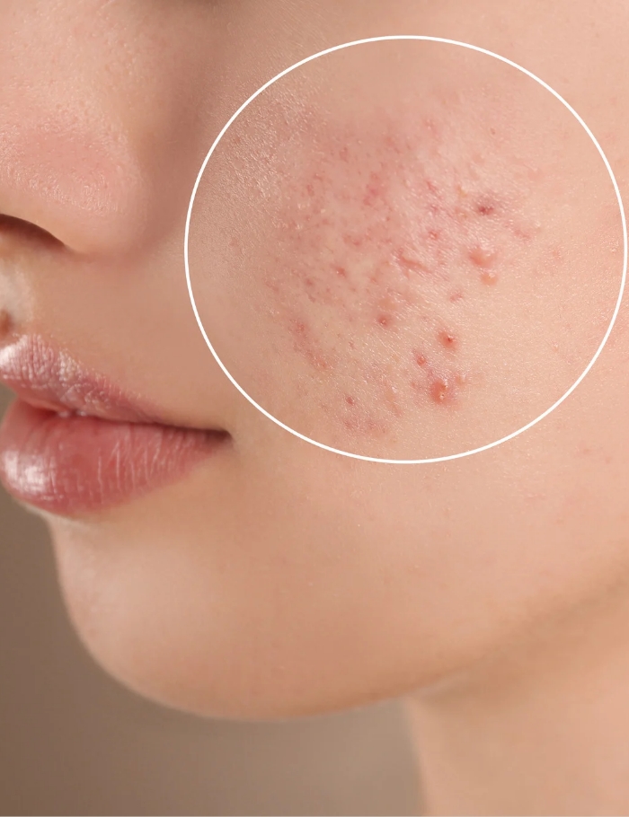 acne scars