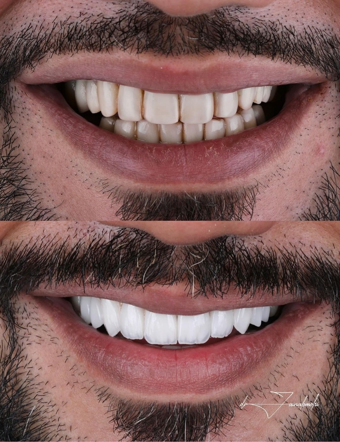 before and after teeth veneer