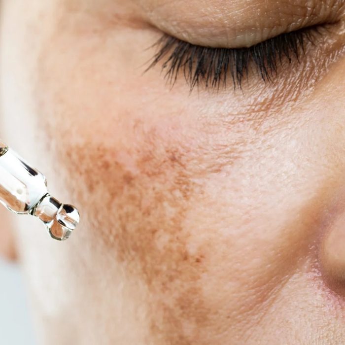 Laser pigmentation removal