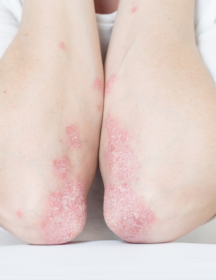 symptoms of psoriasis