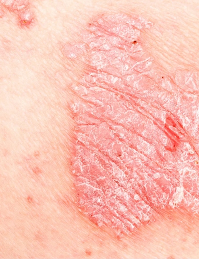 symptoms of psoriasis
