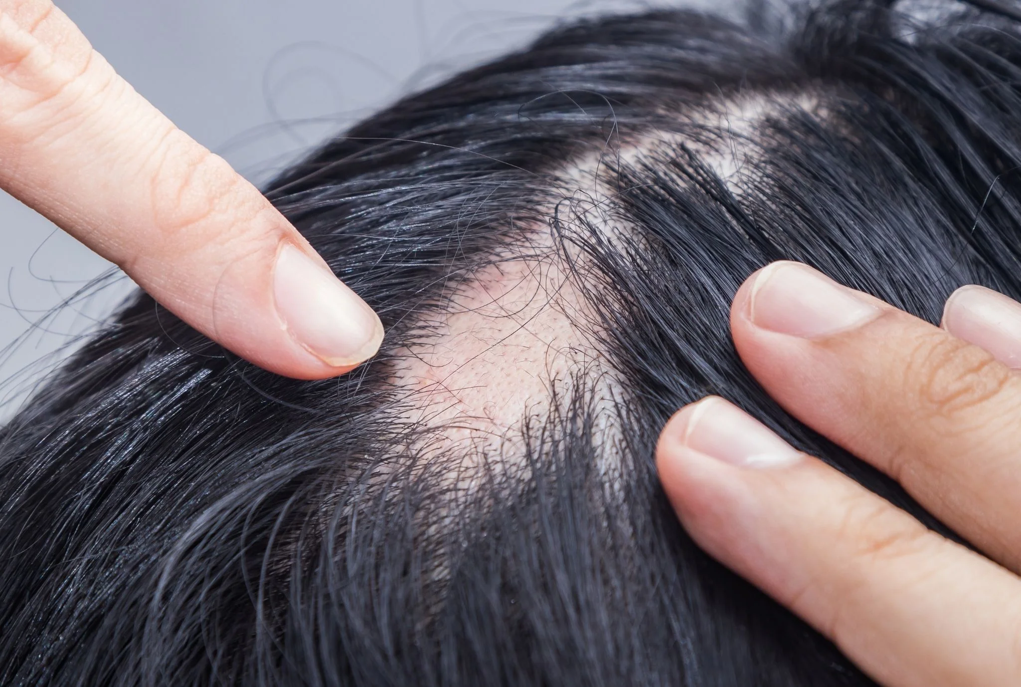 Alopecia treatment at hortman clinics