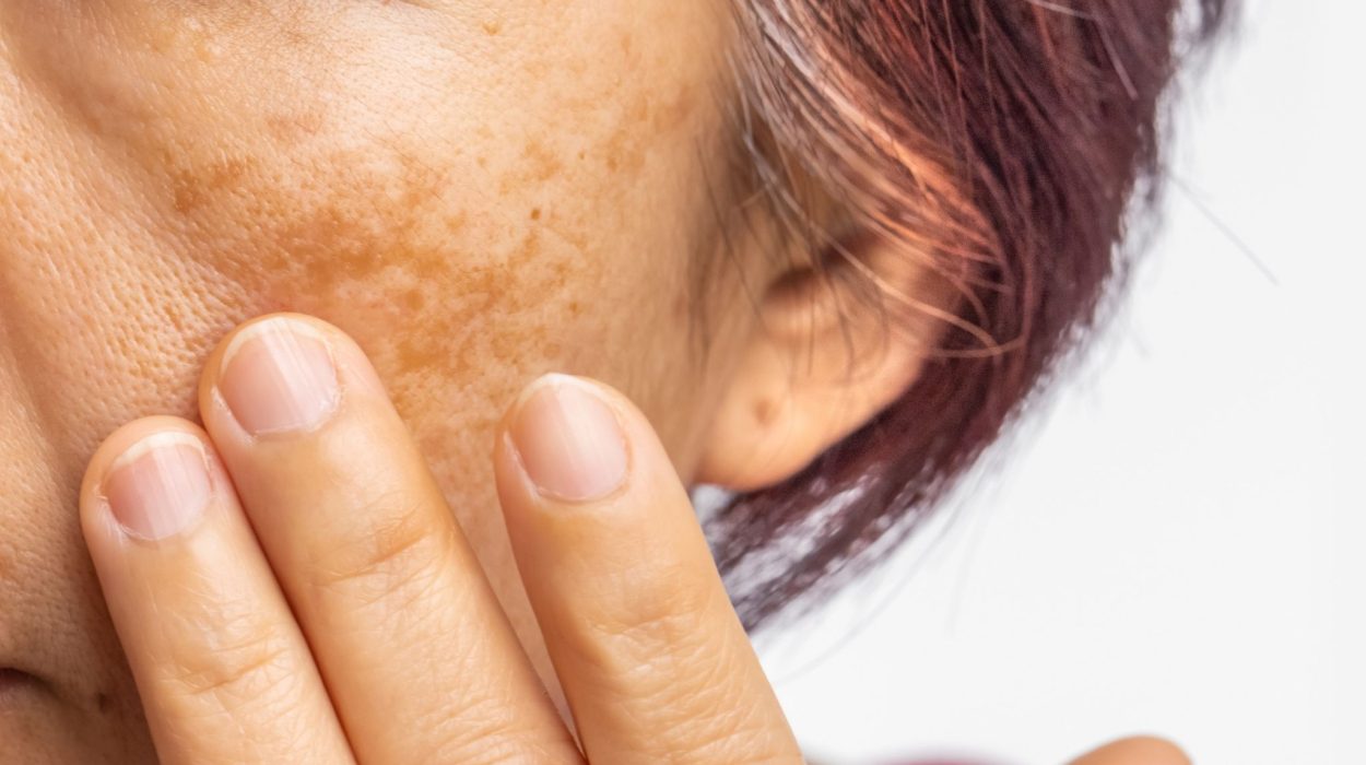 Laser Pigmentation Removal