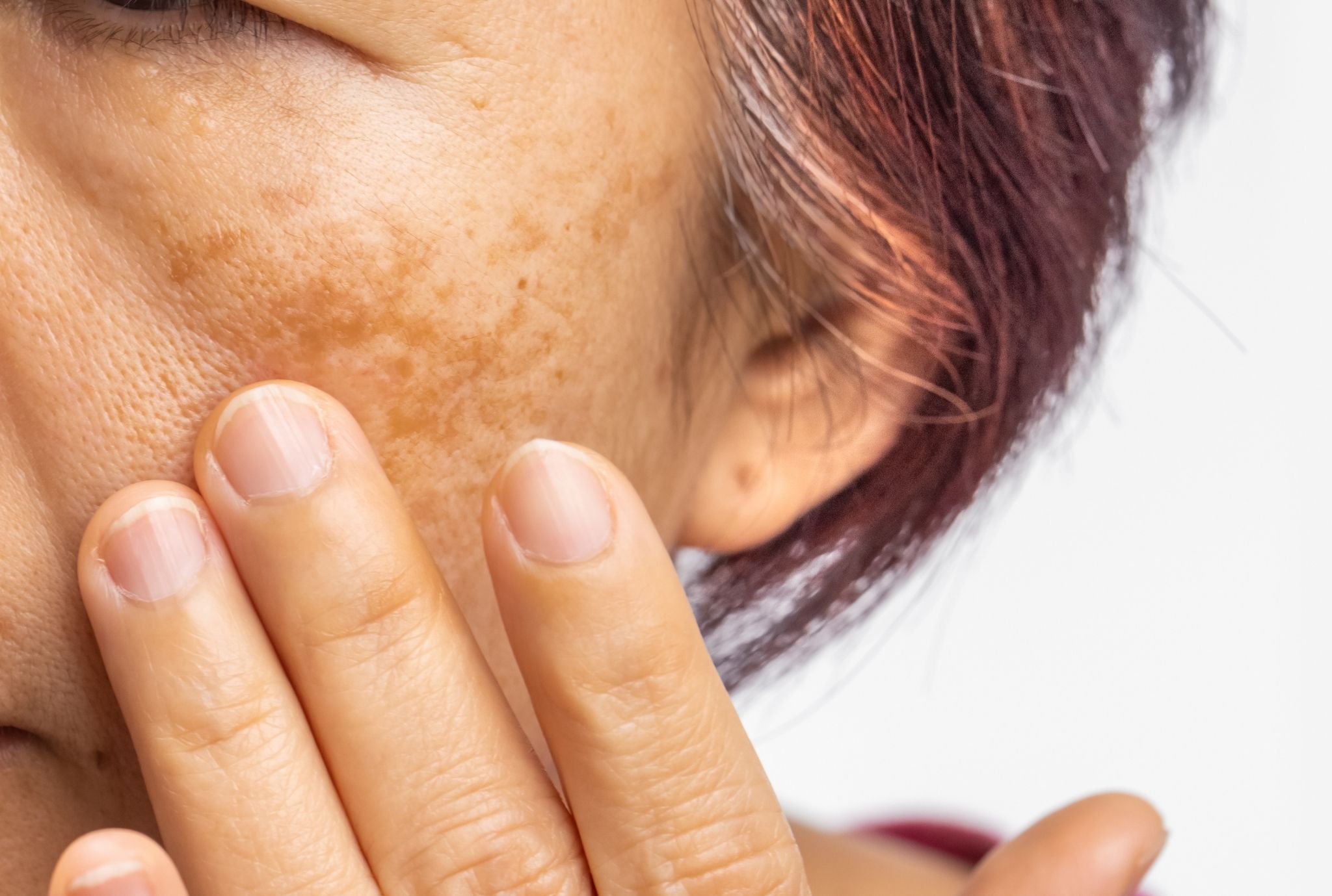 Laser Pigmentation Removal
