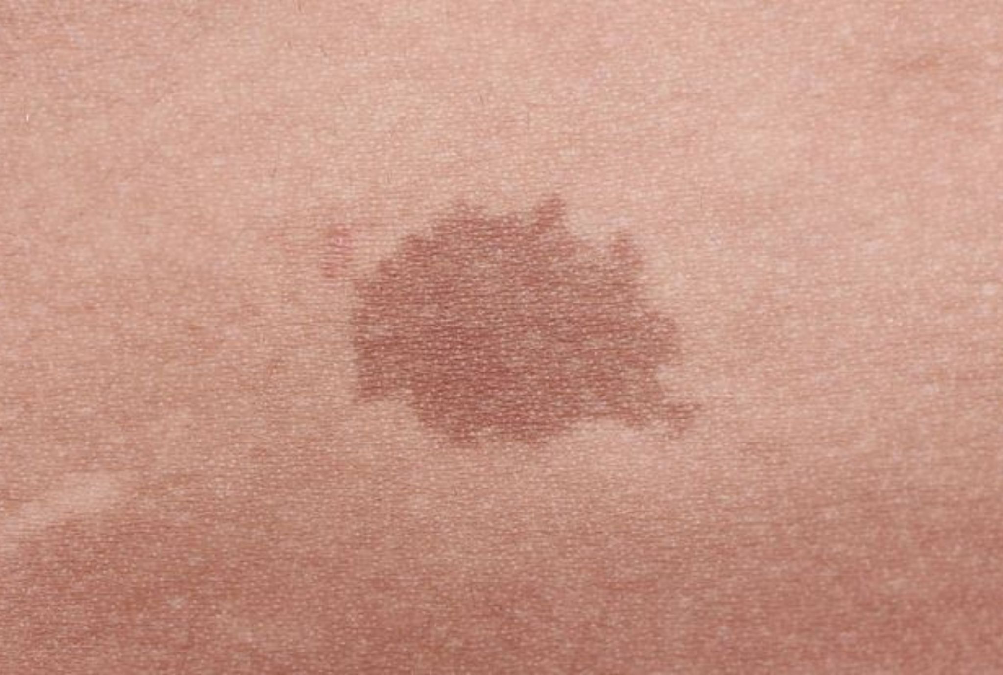 Laser Treatment Birthmark Removal