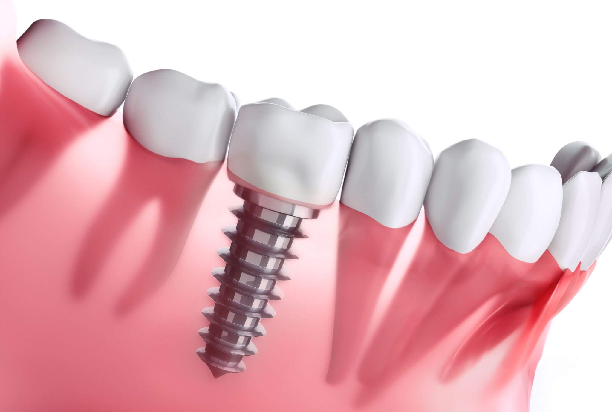 dental implant dubai