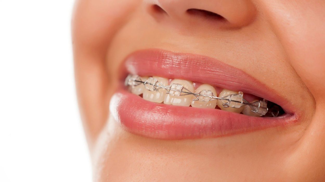 Braces