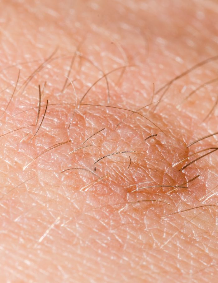 skin tag for removal