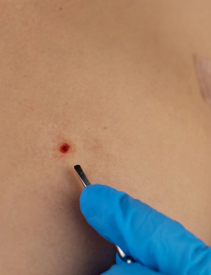 Lesion Excision recovery