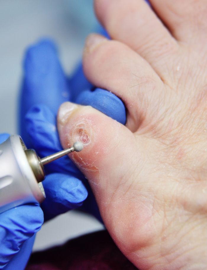 Lesion Excision after care