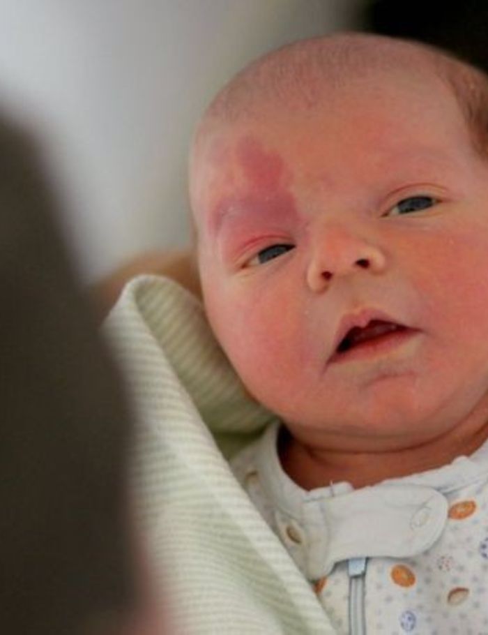 Birth Mark Removal - Hortman Clinics