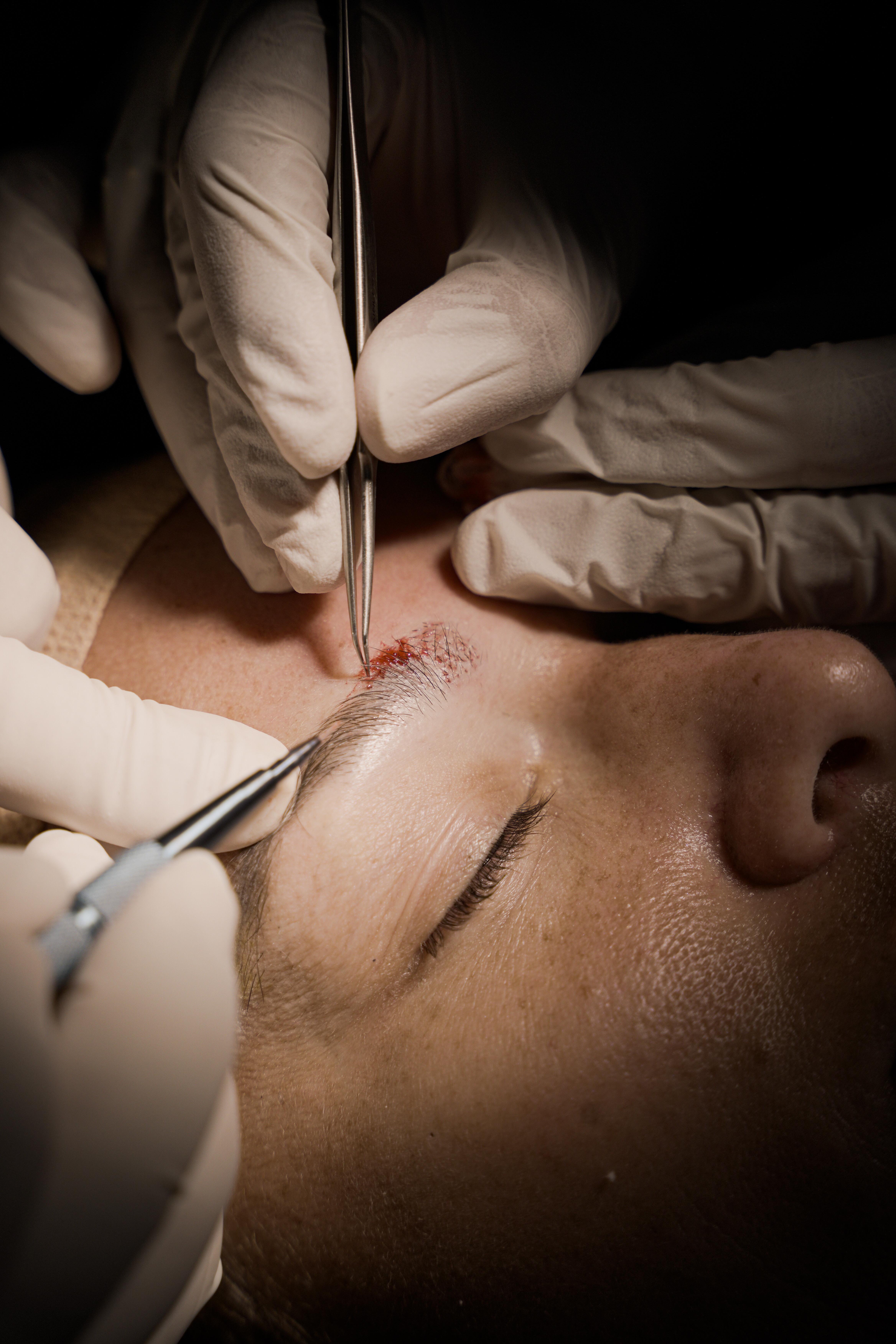 eyebrow transplant
