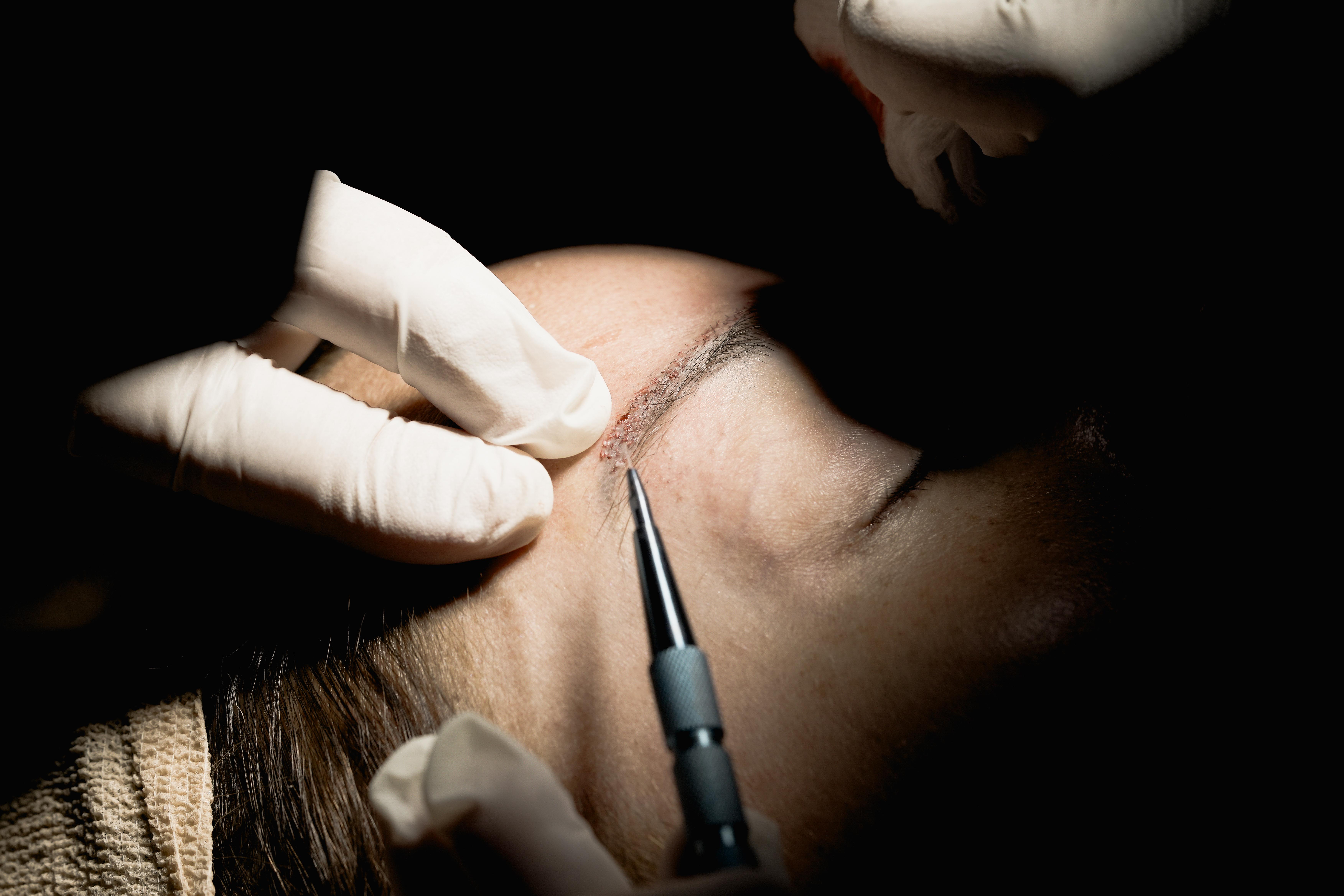 eyebrow transplant dubai