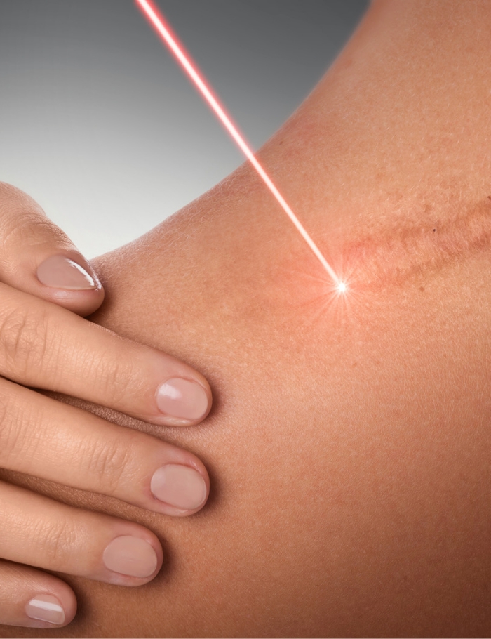 Laser Scar Removal Procedure