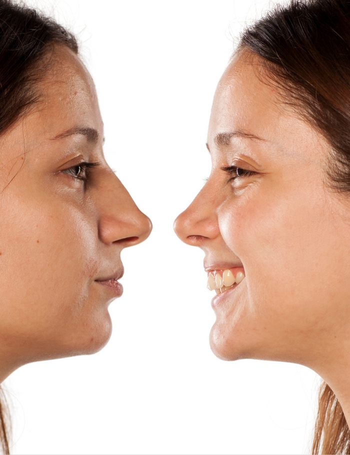 Rhinoplasty Surgery