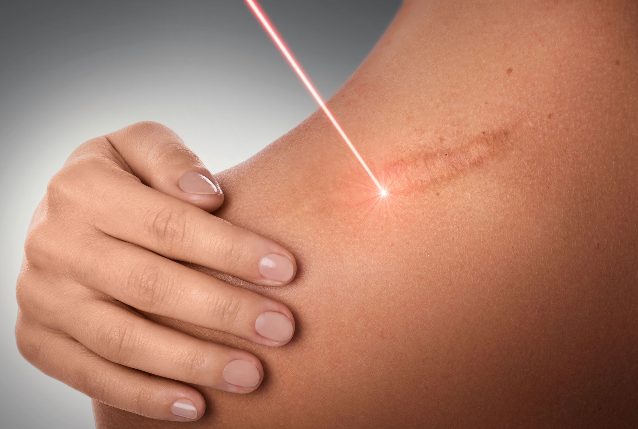 removing scar using laser