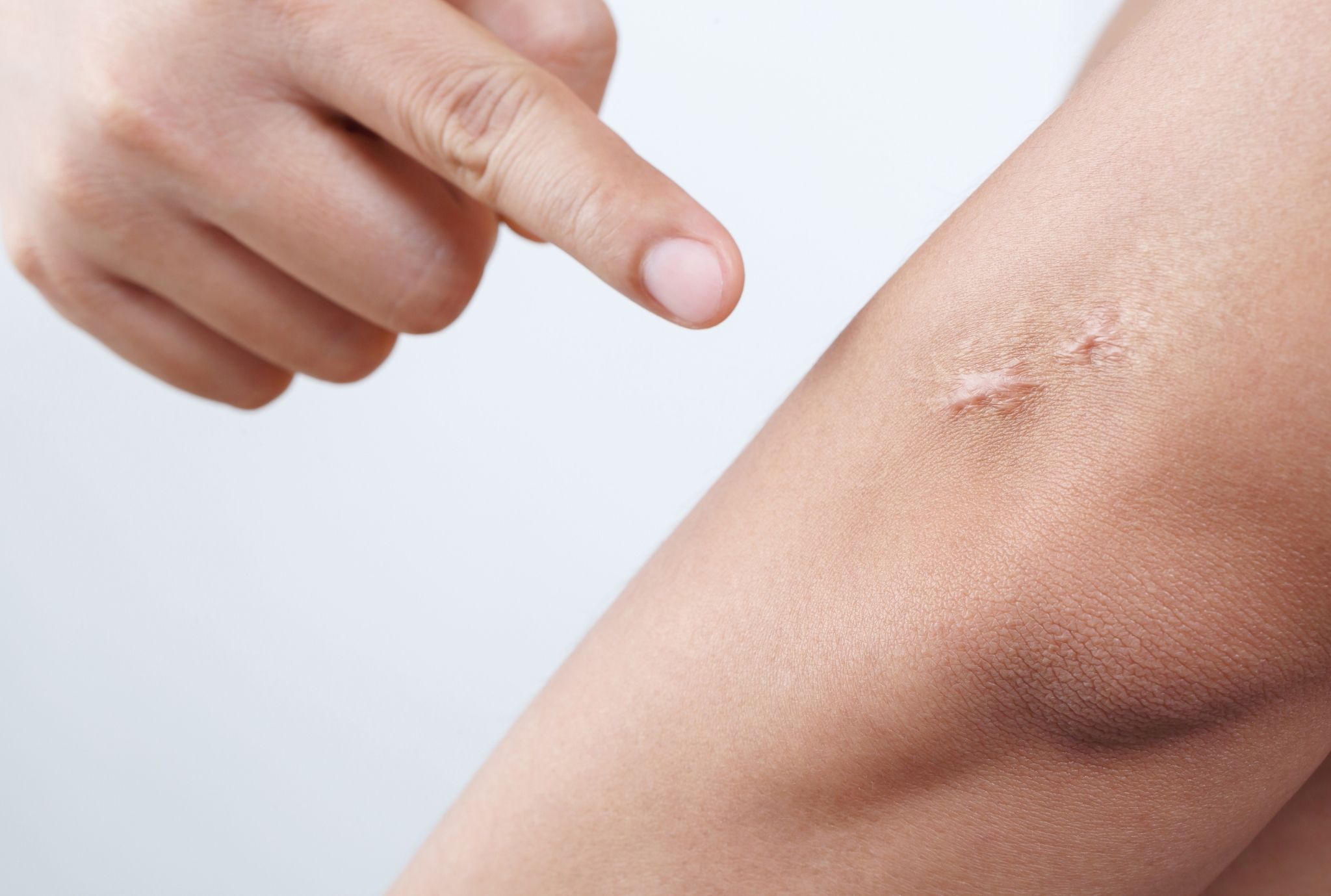 Laser Scar Removal & Revision at Hortman Clinics | Best in Dubai