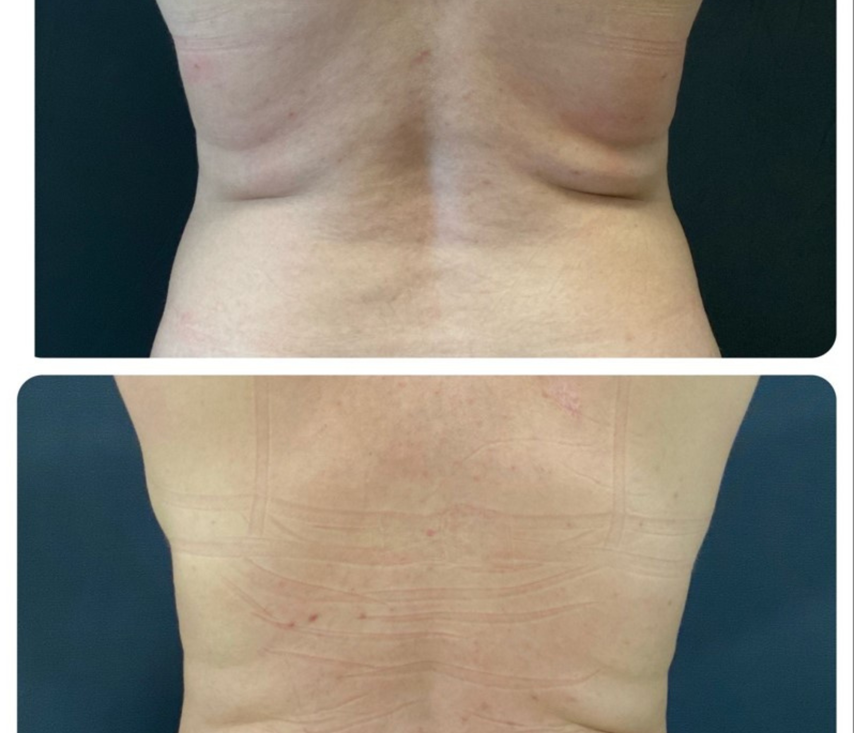 endo lift laser
