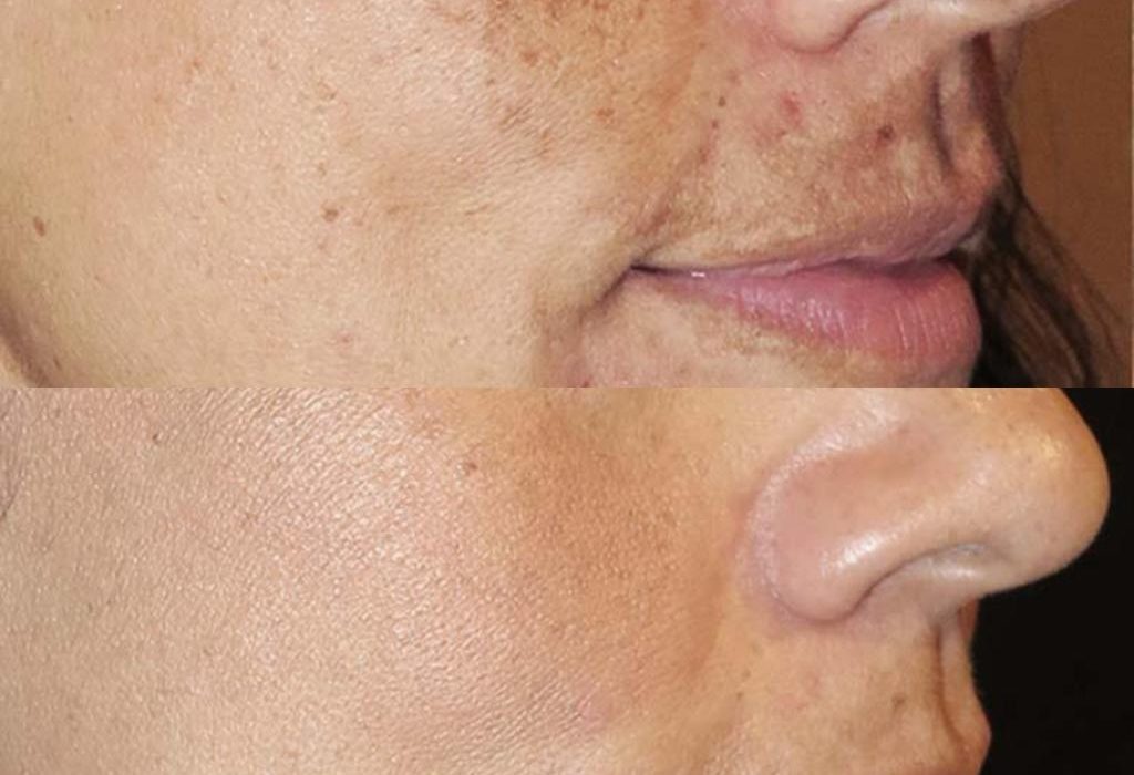 Laser Treatment for Hyperpigmentation