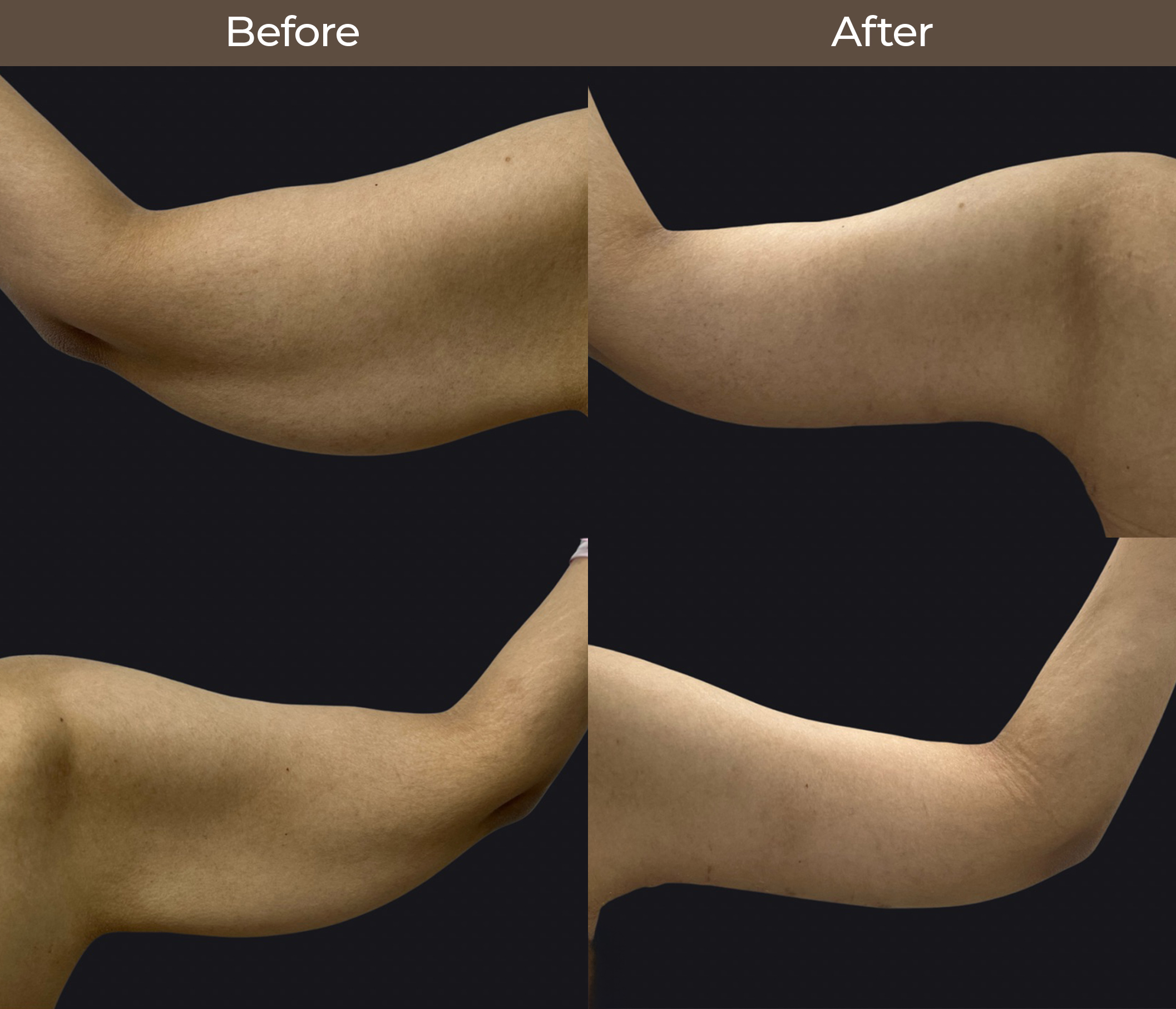 arm surgery