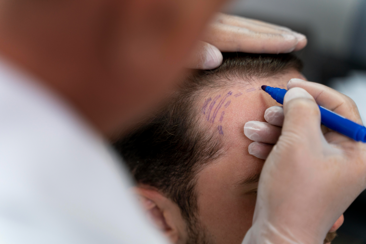 Hair Transplant After Care and Recovery Guide