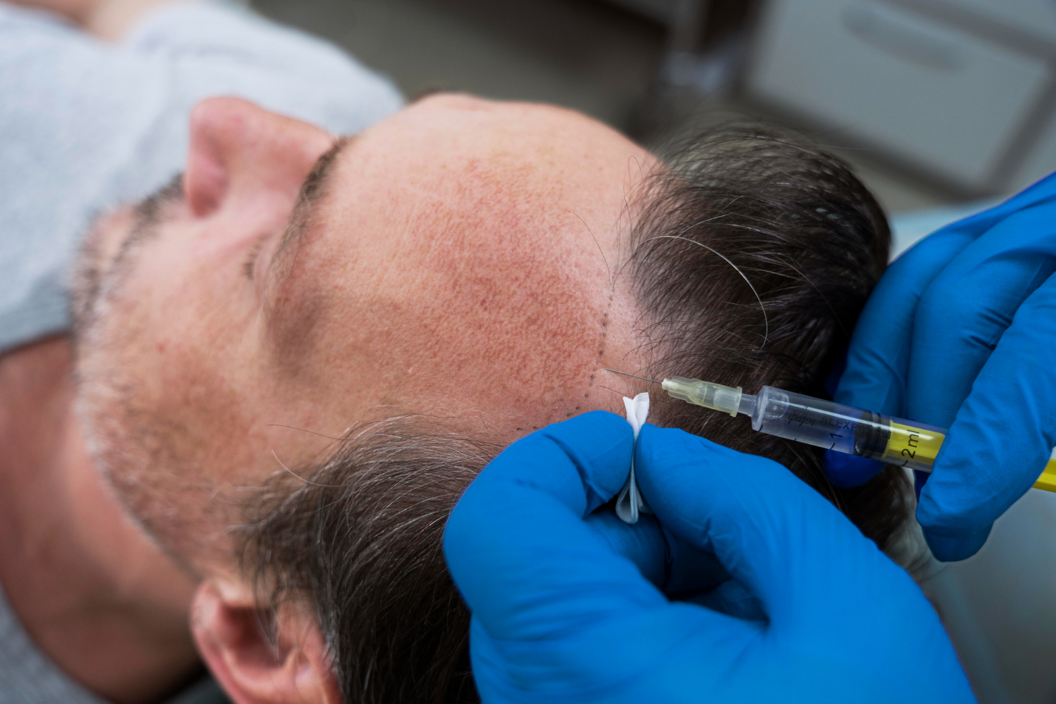 Understanding the PRP Therapy Process After Hair Restoration