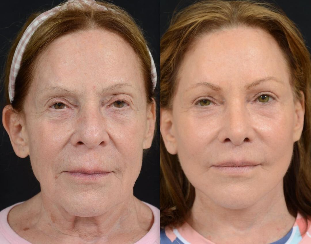 before and after surgery