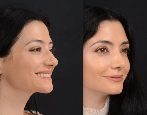 plastic surgery before and after