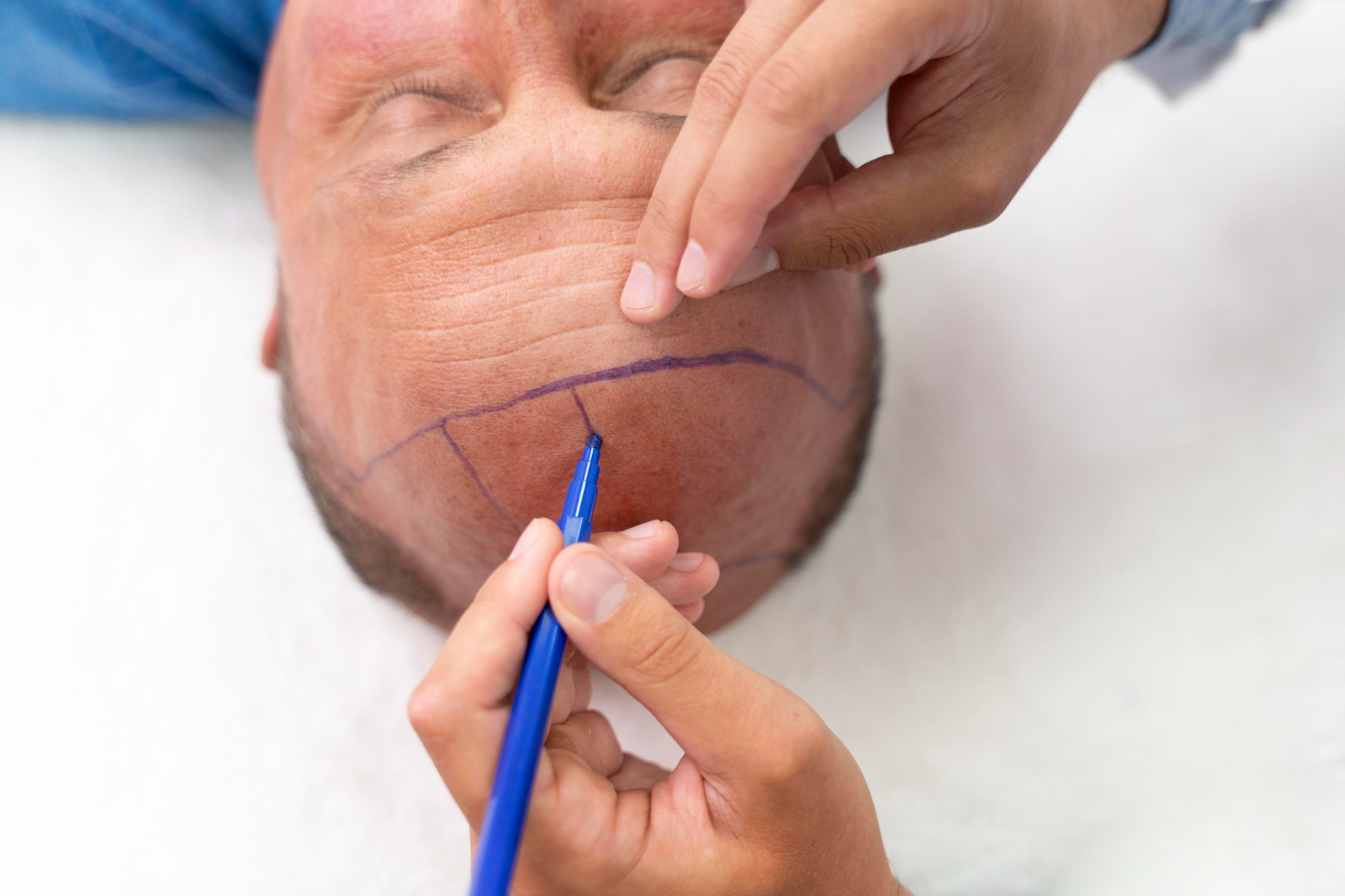 Am I a Good Candidate for a Hair Transplant in Dubai