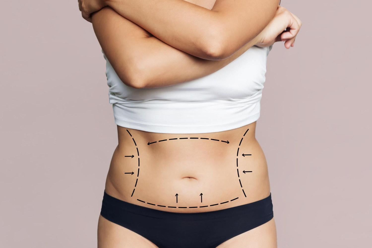 Life After a Tummy Tuck Surgery