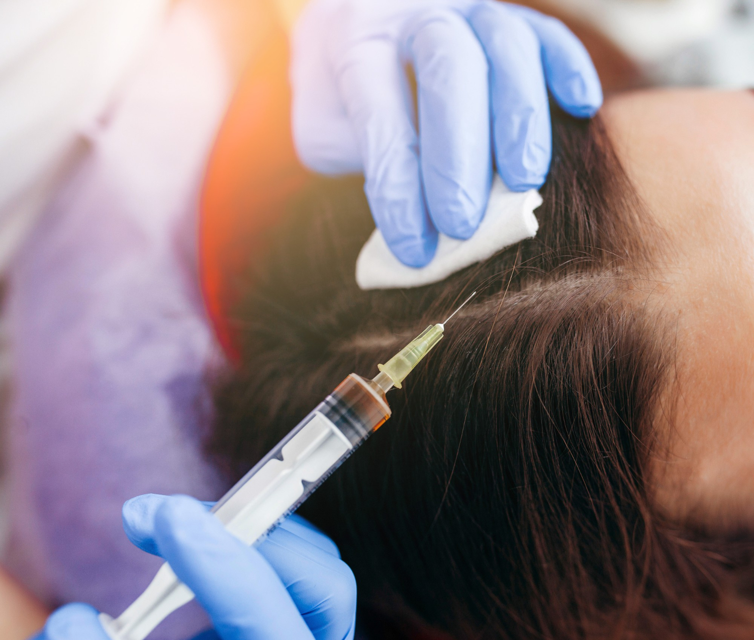 PRP Hair Treatment And Restoration For Natural Results