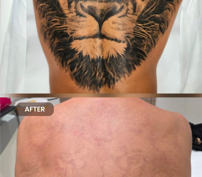 Full Body Tattoo Removal