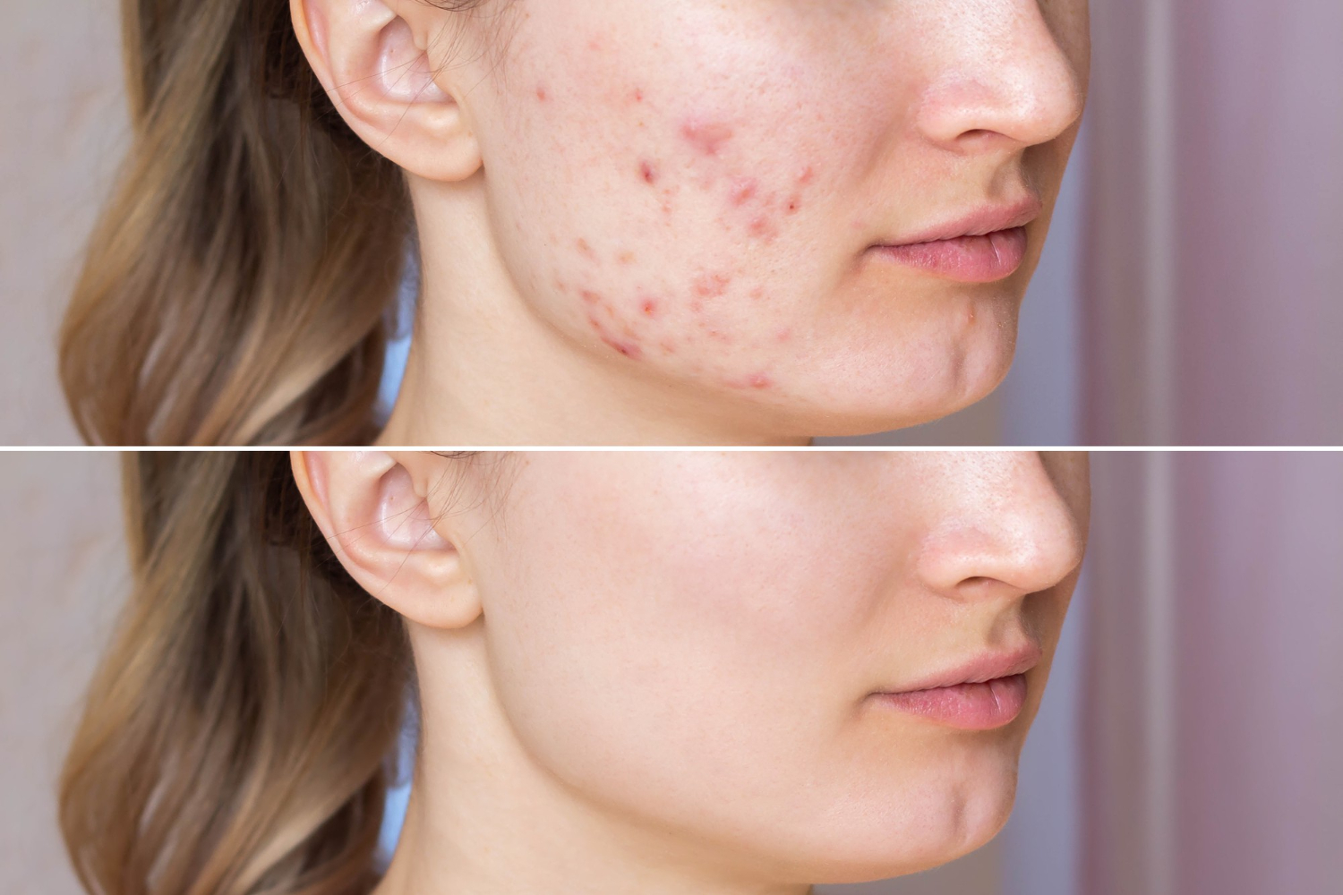 Are You A Candidate For Acne Treatment