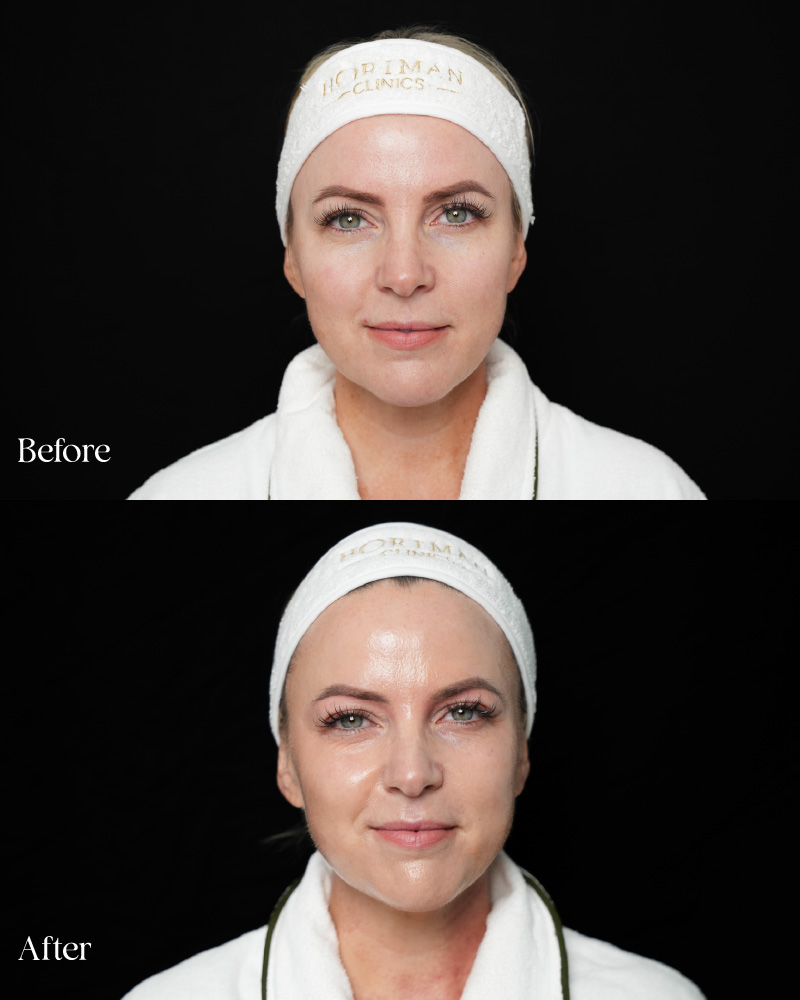 Pico & BBL for Pigmentation Correction
