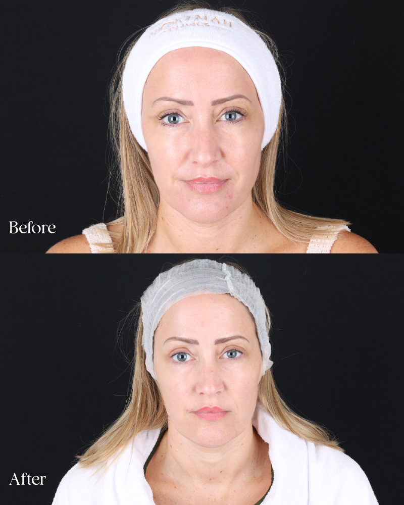 UltraClear for Pigmentation, Redness & Mild Skin Laxity