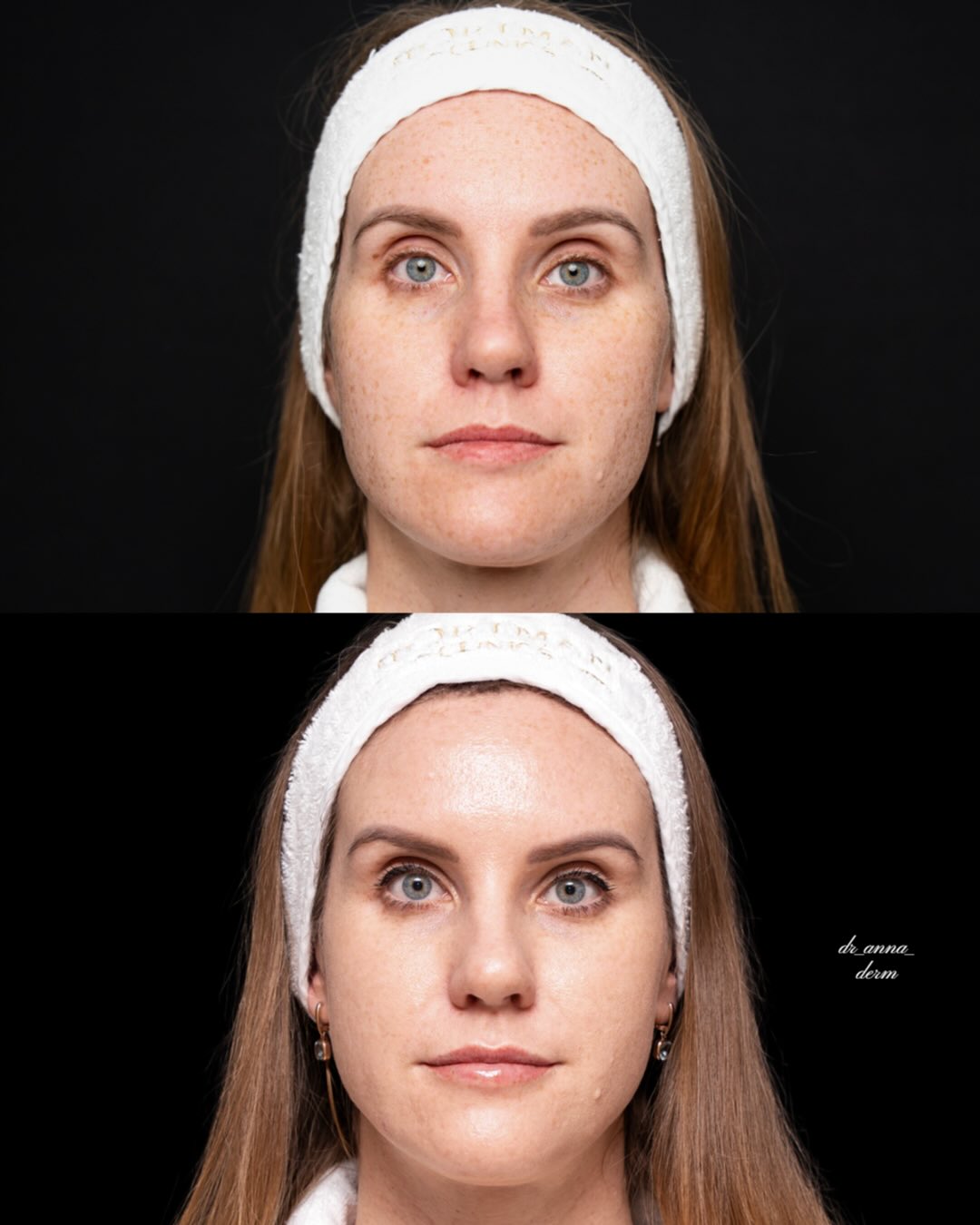 Tear Trough Filler for Under-Eye Volume, and Lip Filler with Lip Flip