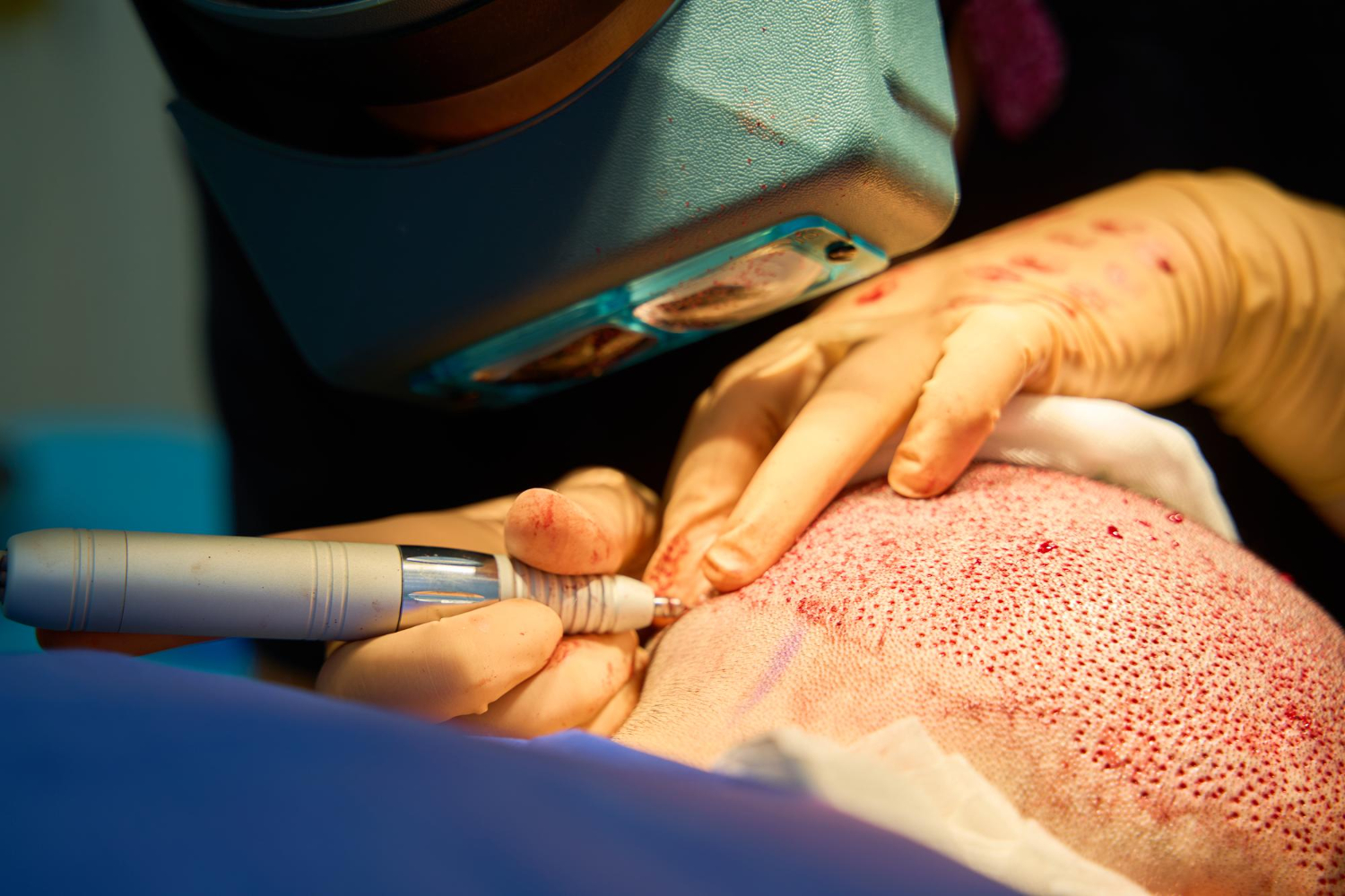 The Ultimate Guide To Hair Transplant Surgery In Dubai