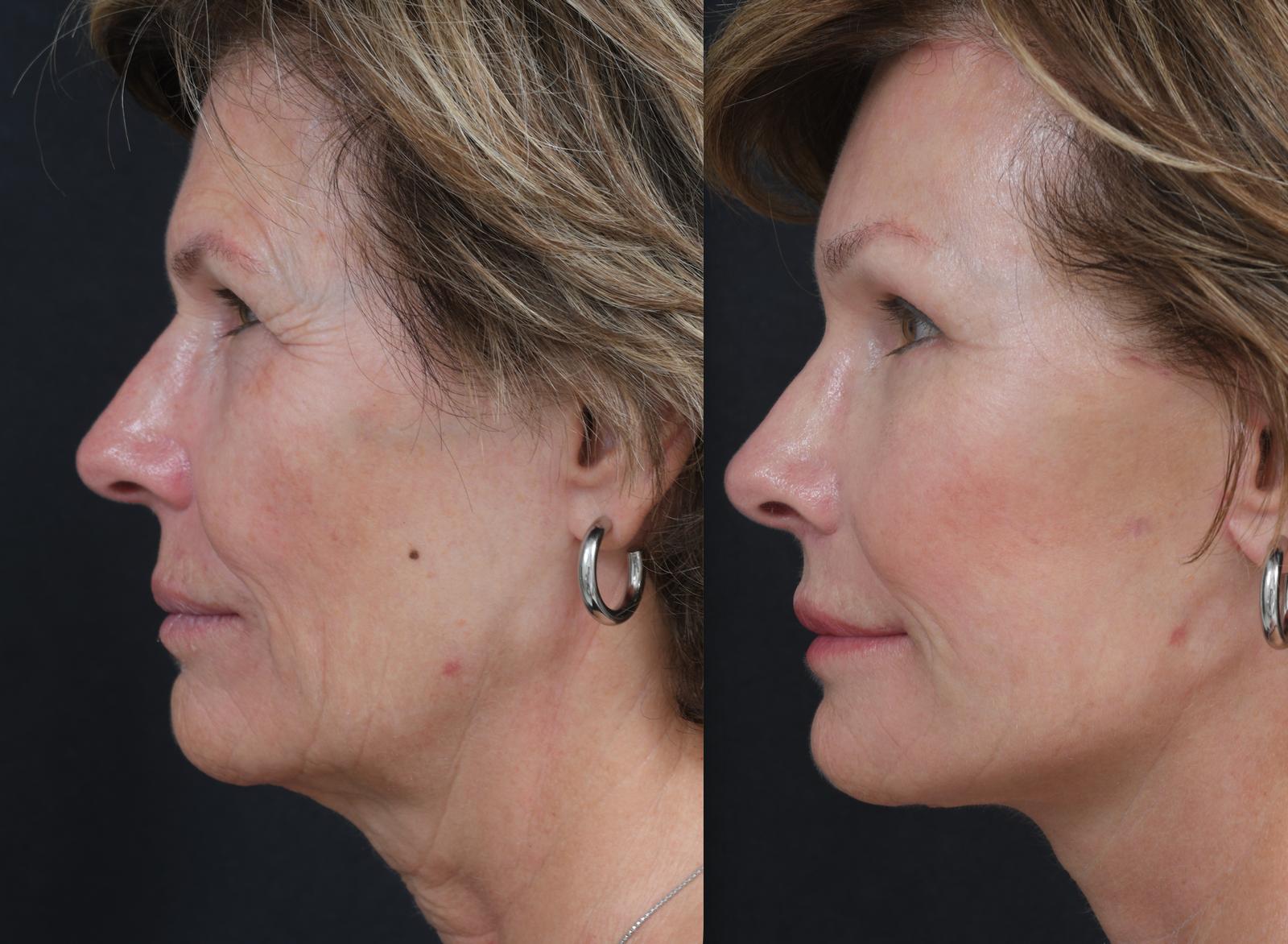 plastic surgery before and after