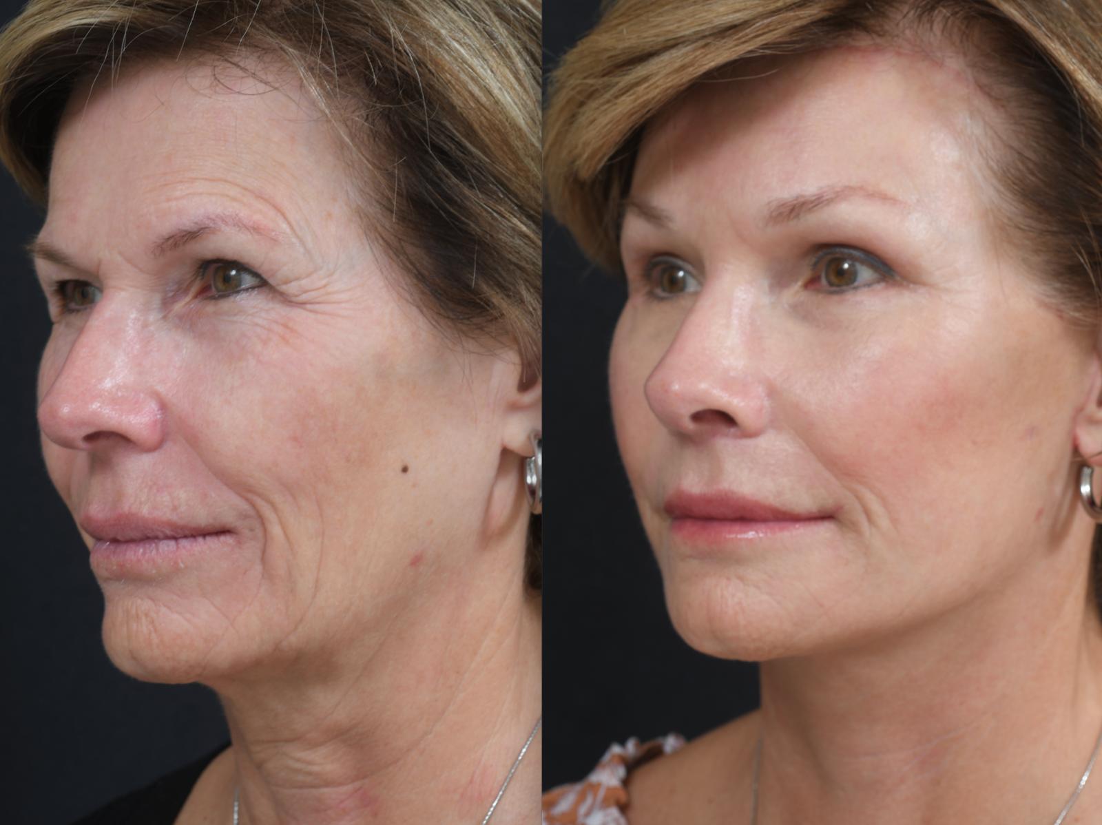 plastic surgery before and after