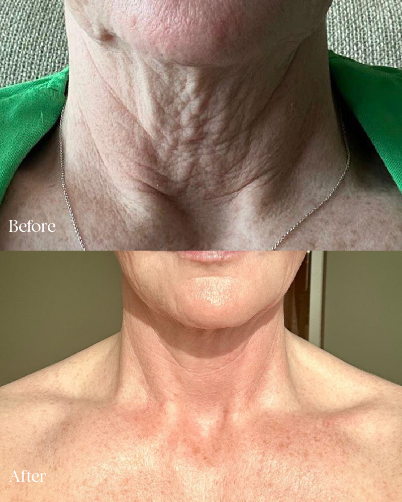 UltraClear for Skin Texture, Tone & Mild Laxity Improvement