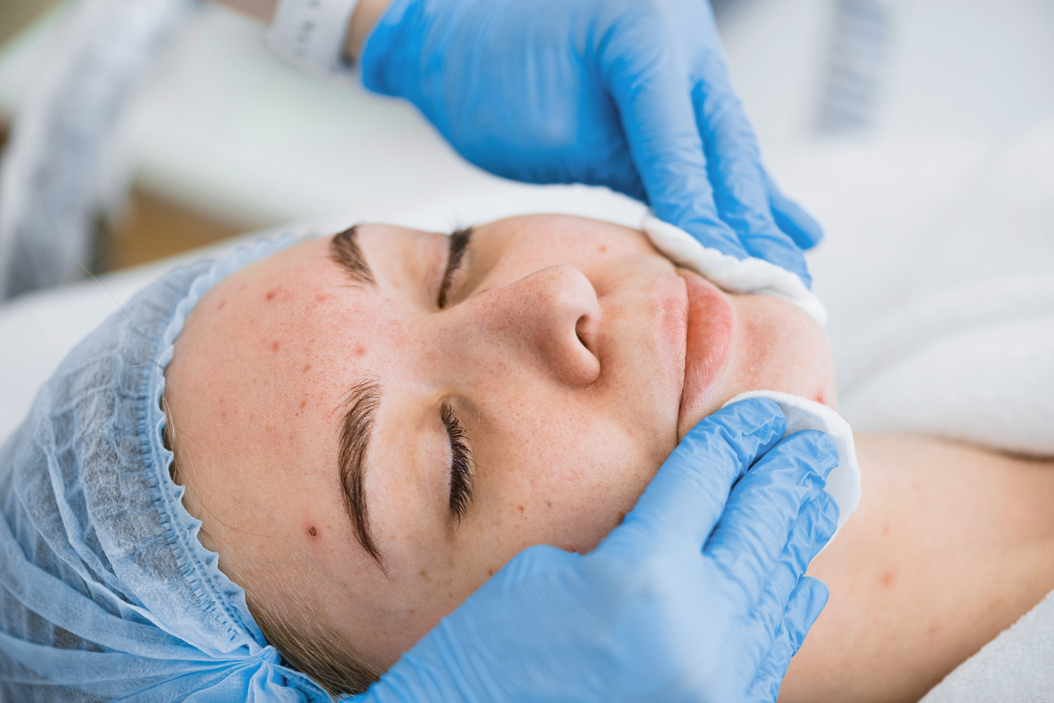 Dermatological Acne Treatments What You Need To Know