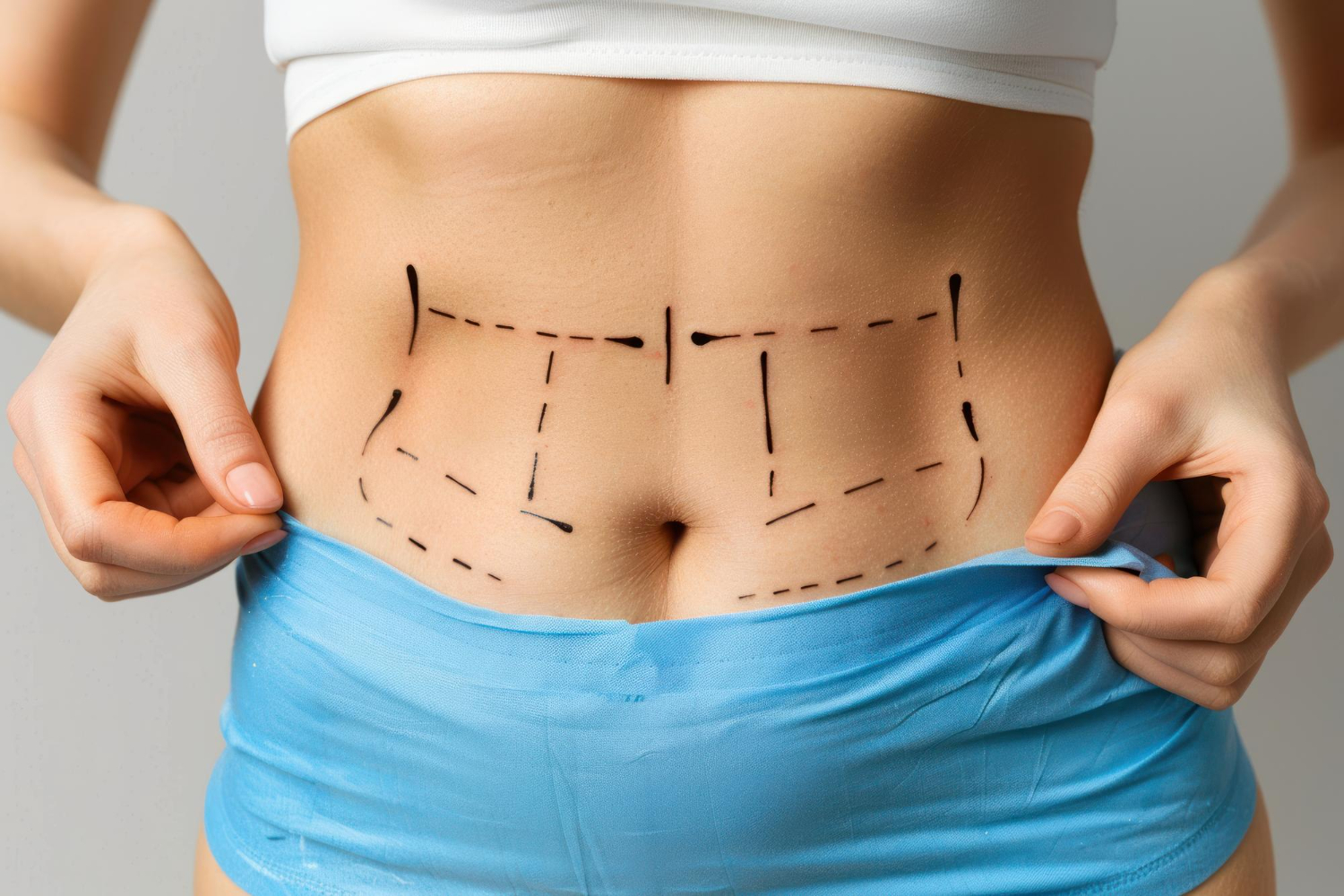 Your Complete Guide To Preparing For A Liposuction Surgery