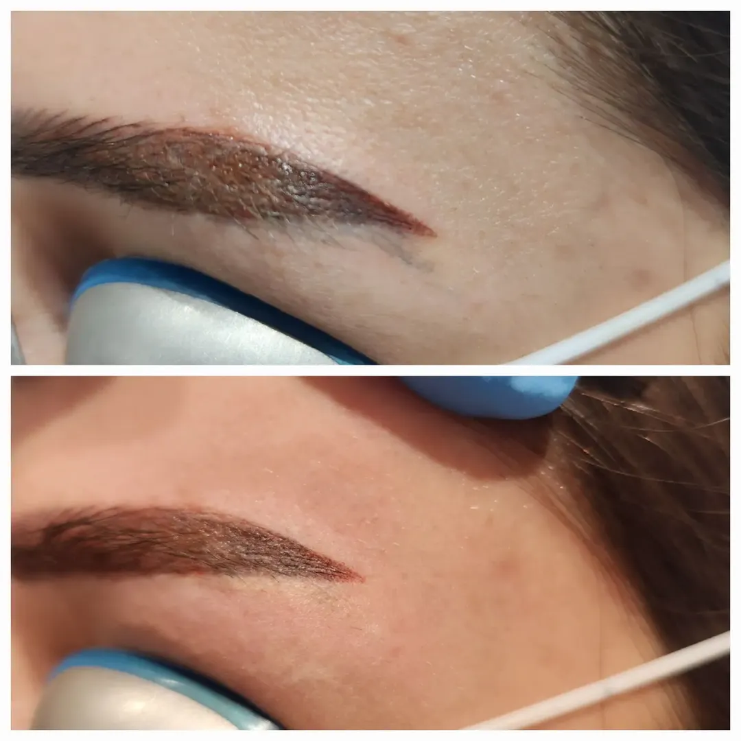 Eyebrow Tattoo Removal Before and After